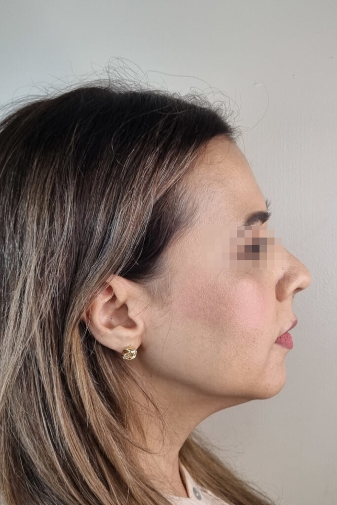 Rinoplastía - Antes y Después