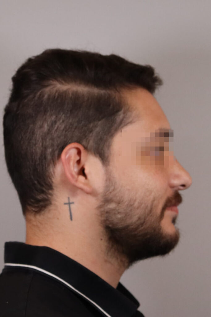 Rinoplastía - Antes y Después