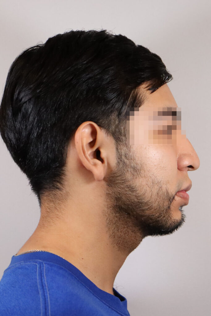 Rinoplastía - Antes y Después