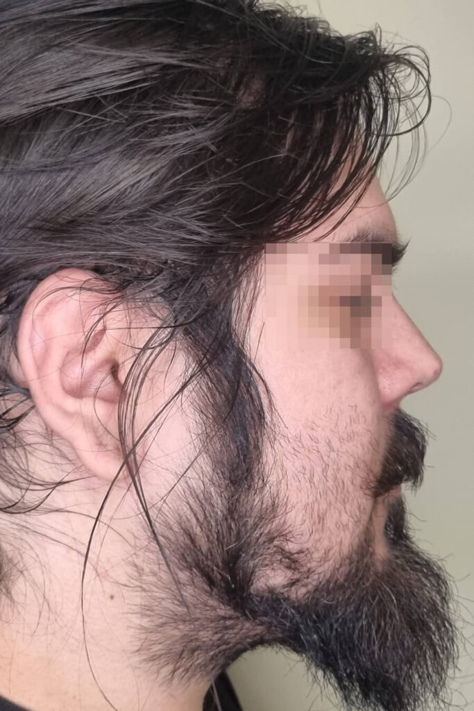 Rinoplastía - Antes y Después