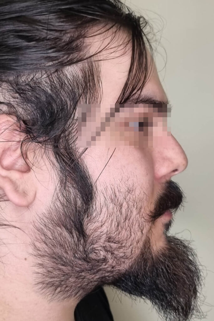 Rinoplastía - Antes y Después