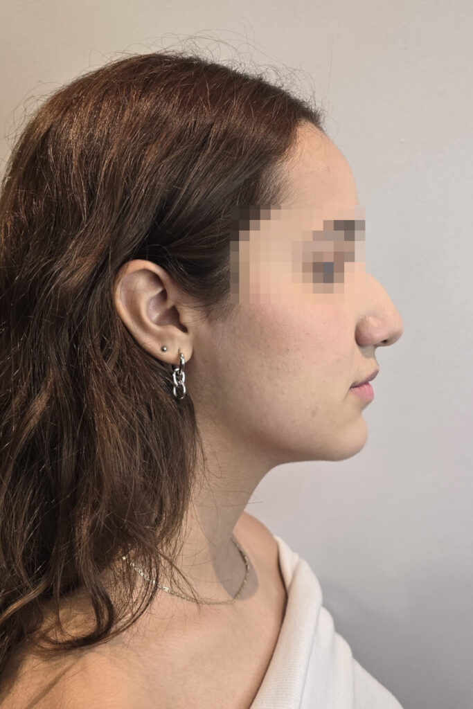 Rinoplastía - Antes y Después